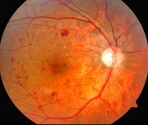 Diyabetik Retinopati Evreleri Nelerdir
