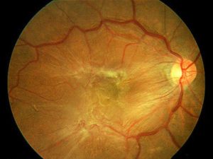 Epiretinal Membran