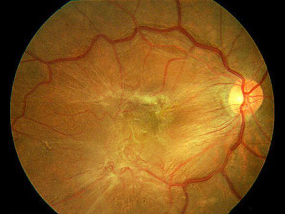 Epiretinal Membran