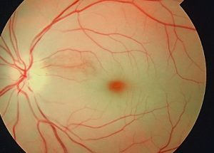 Retina Damar Tıkanıklıkları