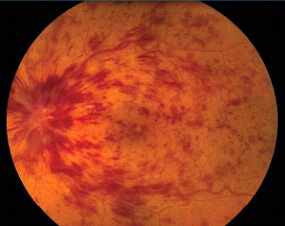 Retina Damar Tıkanıklıkları Belirtisi