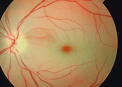 Retina Damar Tıkanıklıkları
