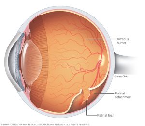 Retina Dekolmanı Belirtileri Nelerdir?