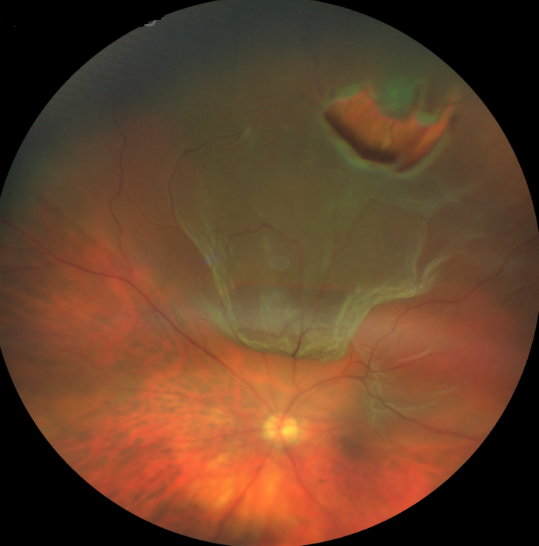 Retina Dekolmanı Riskleri Nedir